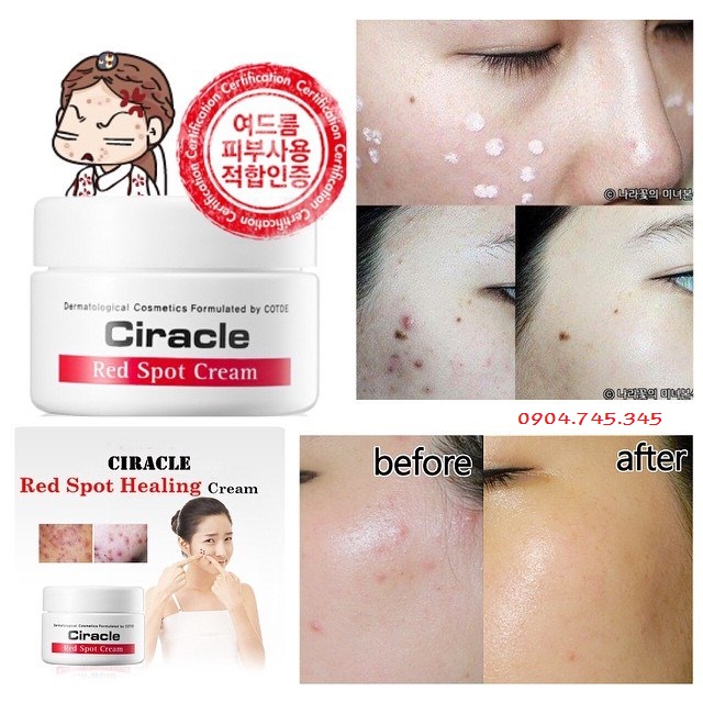 tri-mun-kem-tri-mun-tham-ciracle-red-spot-cream-han-quoc-3351