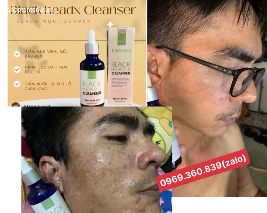 tri-mun-serum-mun-giam-nhon-ladamer-black-head-x-cleanser-han-quoc-7804