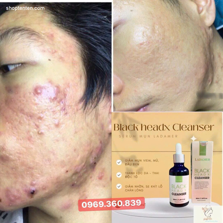 tri-mun-serum-mun-giam-nhon-ladamer-black-head-x-cleanser-han-quoc-7804