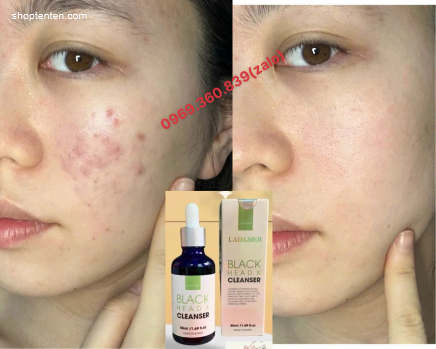 tri-mun-serum-mun-giam-nhon-ladamer-black-head-x-cleanser-han-quoc-7804