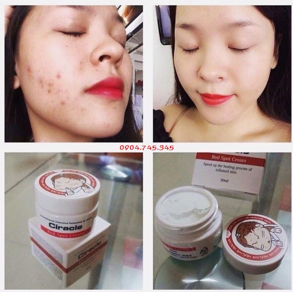 tri-mun-kem-tri-mun-tham-ciracle-red-spot-cream-han-quoc-3351